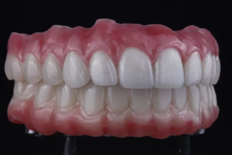 All on 6 dental implants by TKC Pain free same day full mouth implants