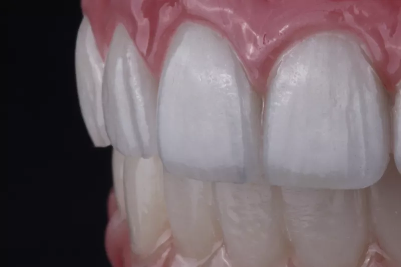 close up all on 6 implants Missing teeth from Gum disease treatment