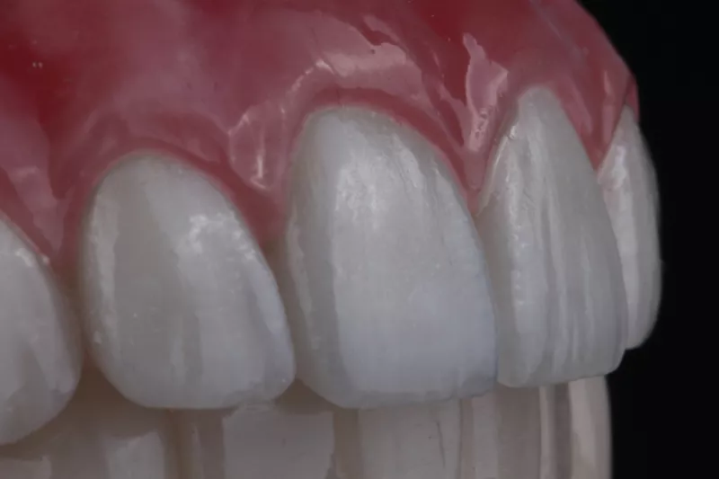 Close up All on 6 implants Customised dental implants by Dr Sheraz Aleem