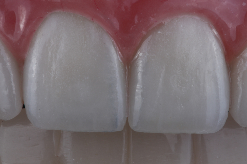 No bone solutions for missing teeth at The Knightsbridge Clinic