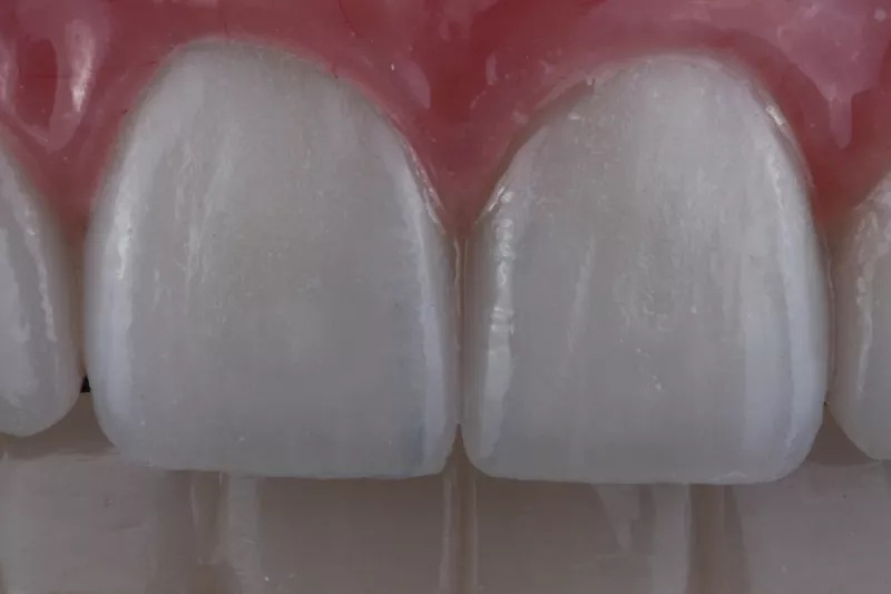 close up all on 6 implants No bone solutions for missing teeth at The Knightsbridge Clinic