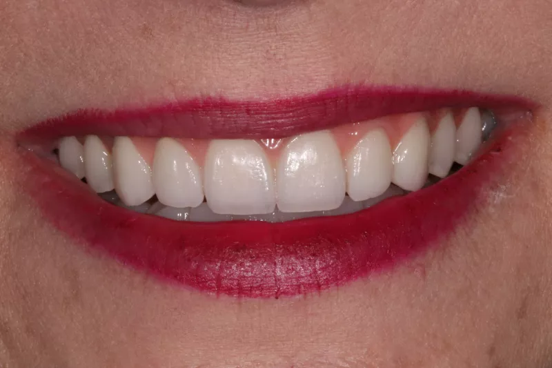 After full mouth dental implants