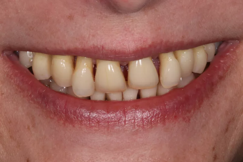Wobbly teeth before dental implants