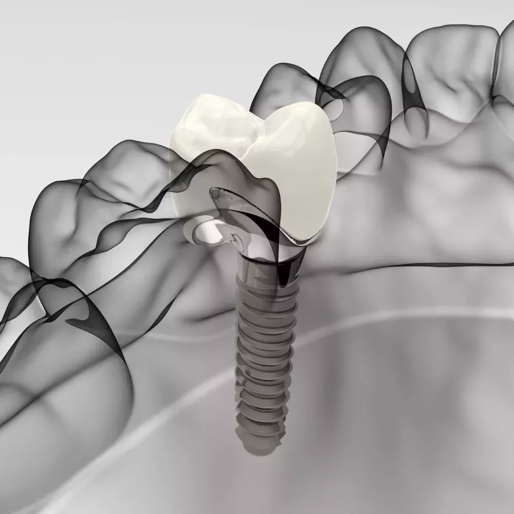 TKC Dental Implants Dental Implants