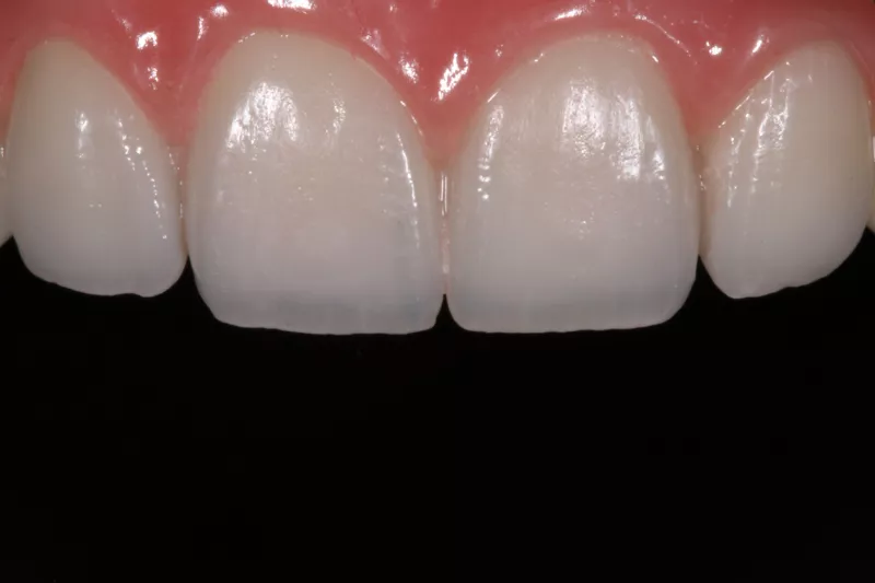 All-on-6 Dental Implants by Dr Aleem