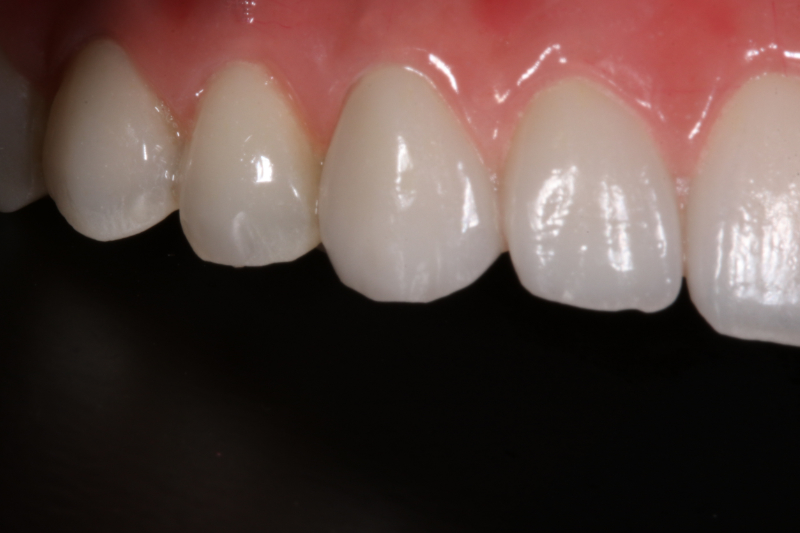 All-on-6 Dental Implants by Dr Aleem