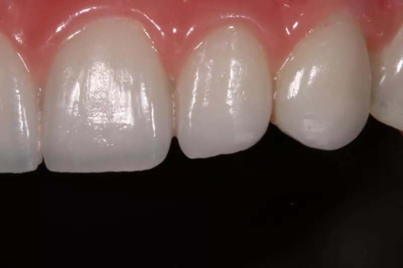 All-on-6 Dental Implants by Dr Aleem