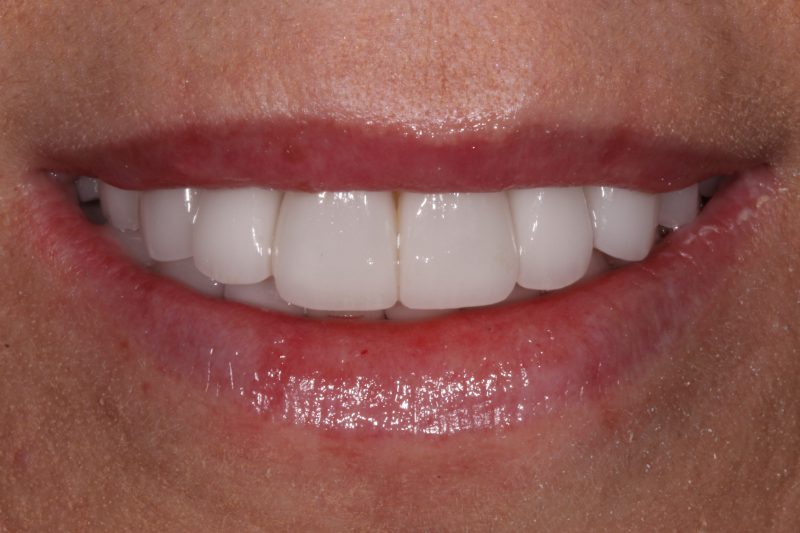 Smile Design by Dr Sheraz Aleem