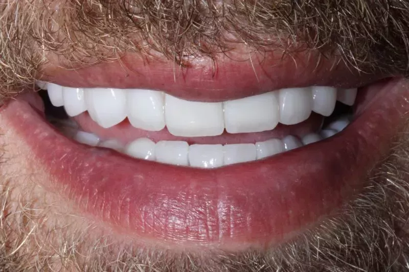 Full Mouth Non-cutting Veneers by Dr Aleem