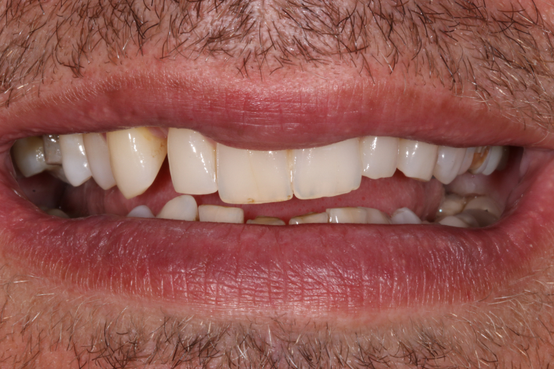 Before full mouth Porcelain Veneers