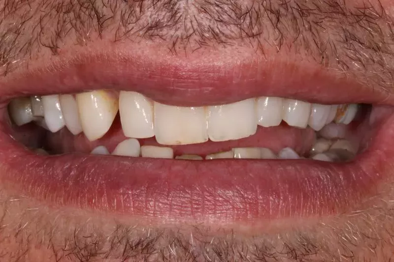 Before full mouth Porcelain Veneers