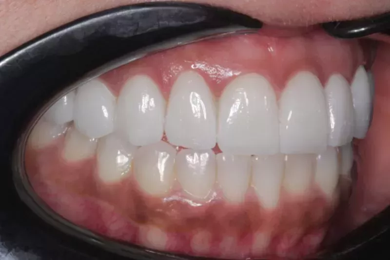 Non cutting Porcelain Veneers by Dr Sheraz A
