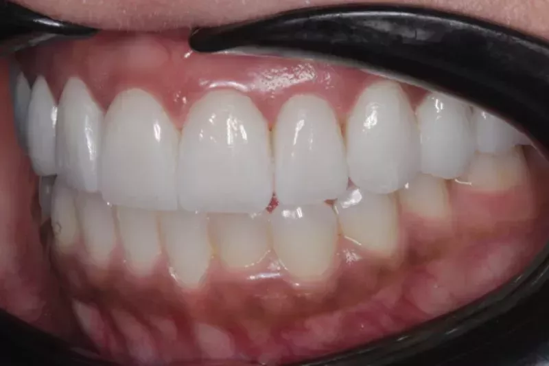 Non cutting Porcelain Veneers by Dr Sheraz