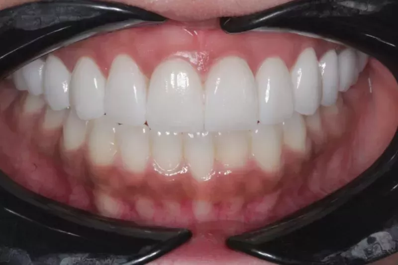 No damage to natural teeth veneers