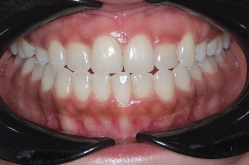 Before dental veneers and gum contour