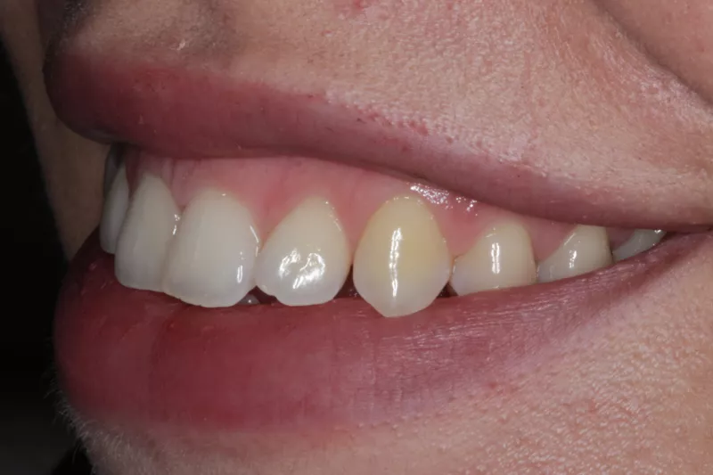 Before Invisalign treatment Before Invisalign treatment