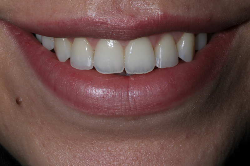 Straight teeth after Invisalign Aligners