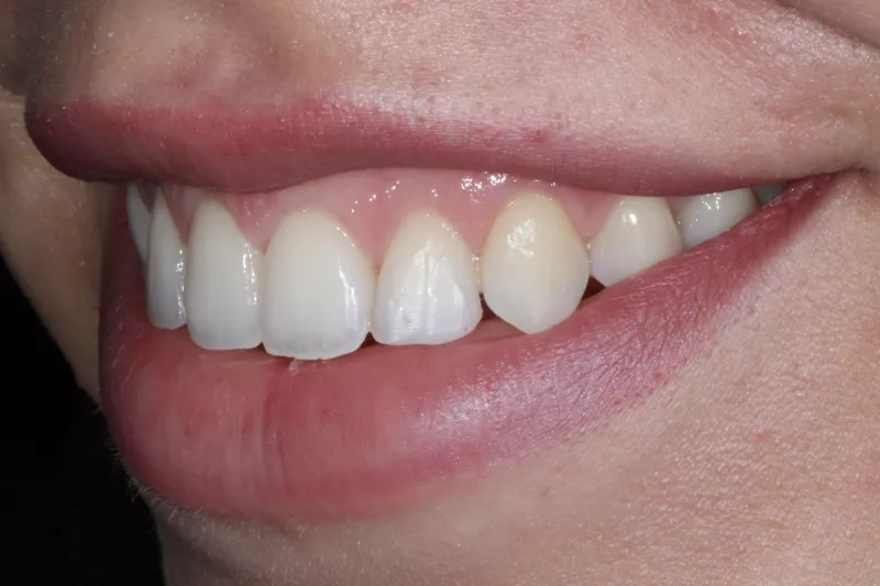 Teeth after Invisalign Teeth after Invisalign