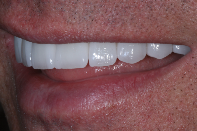 After Porcelain veneers the difference