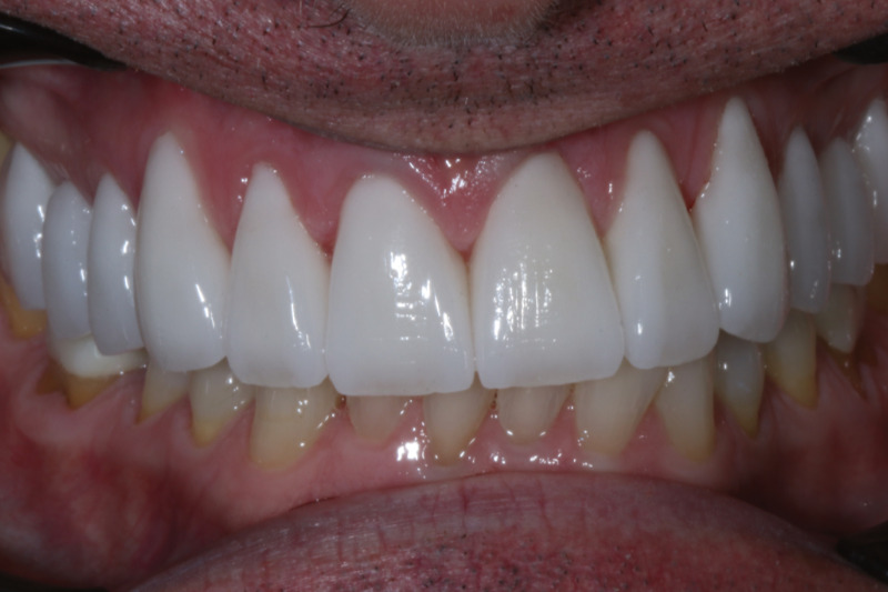 After Porcelain veneers the difference