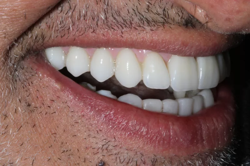Full Mouth implants by Dr Aleem