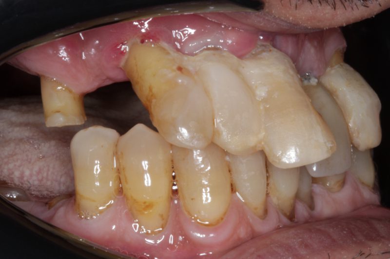 Before full mouth implants