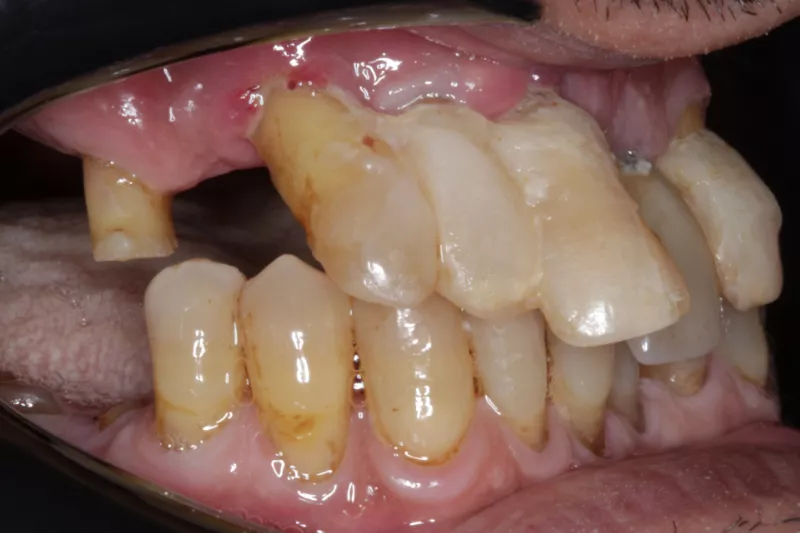 Before full mouth implants