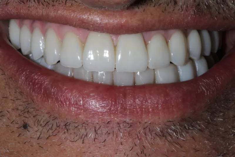 Full Mouth restoration The Knightsbridge Clinic