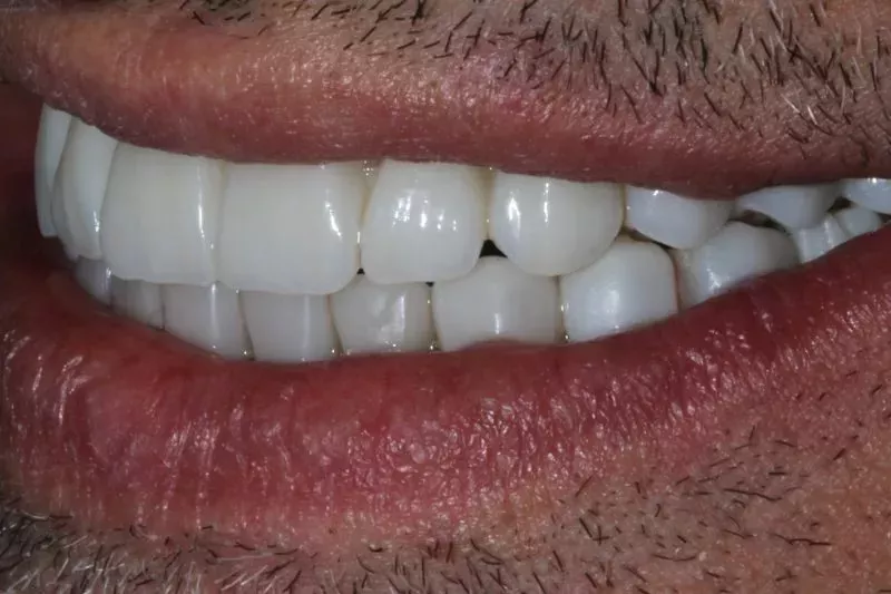 what are Dental Implant types