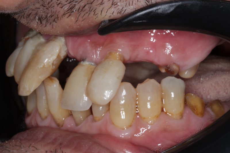 Before full mouth implants