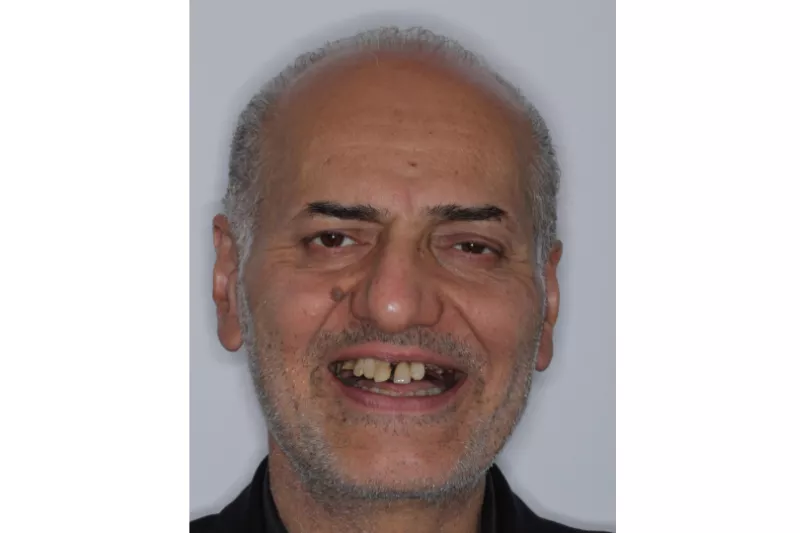 Before Full Mouth Implants