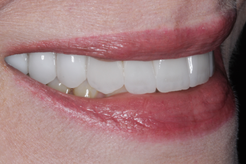 After Veneers The Knightsbridge Clinic