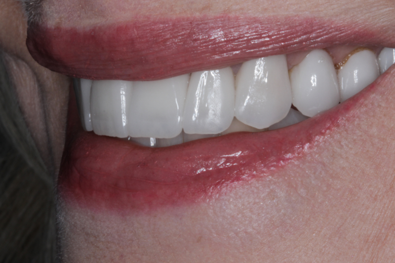 After porcelain veneers
