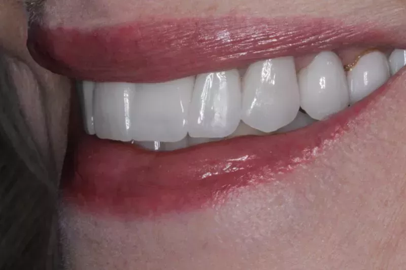 After porcelain veneers
