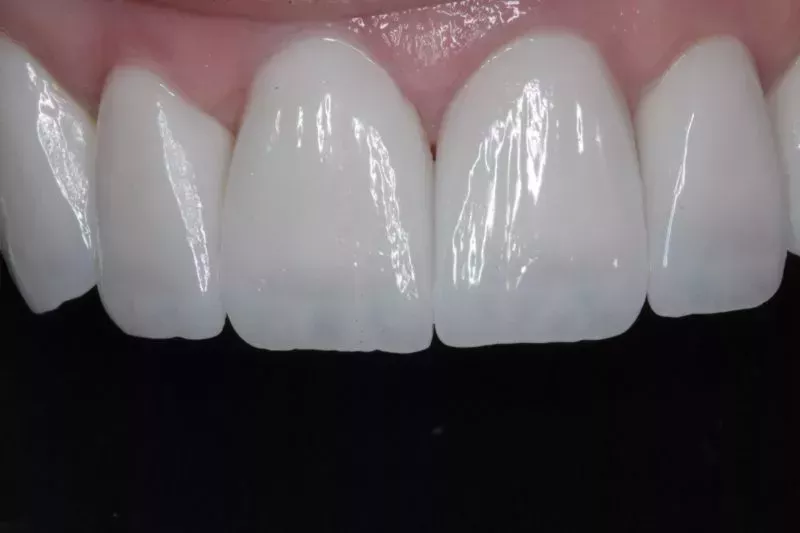 No Damage Porcelain Veneers