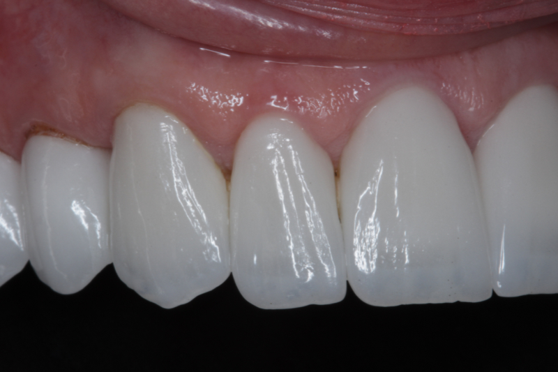 After Veneers The Knightsbridge Clinic