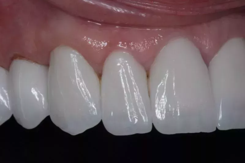 After Veneers The Knightsbridge Clinic