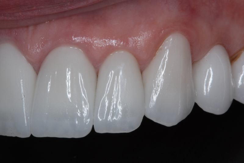 After Veneers The Knightsbridge Clinic