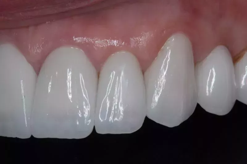 After Veneers The Knightsbridge Clinic