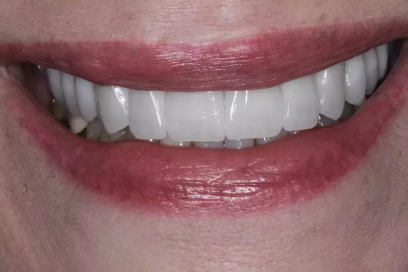 after Veneers The Knightsbridge Clinic