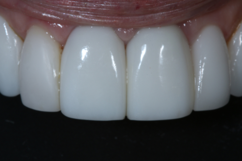 Before Porcelain veneers the difference