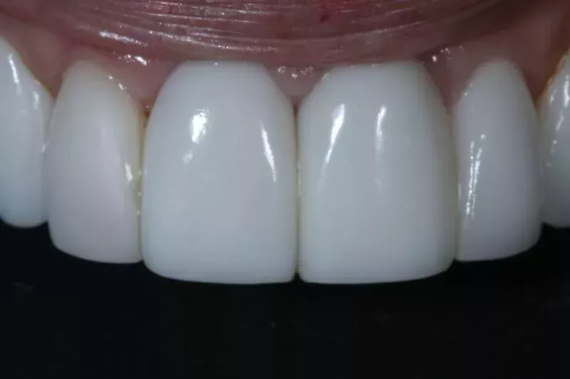 Before Porcelain veneers the difference