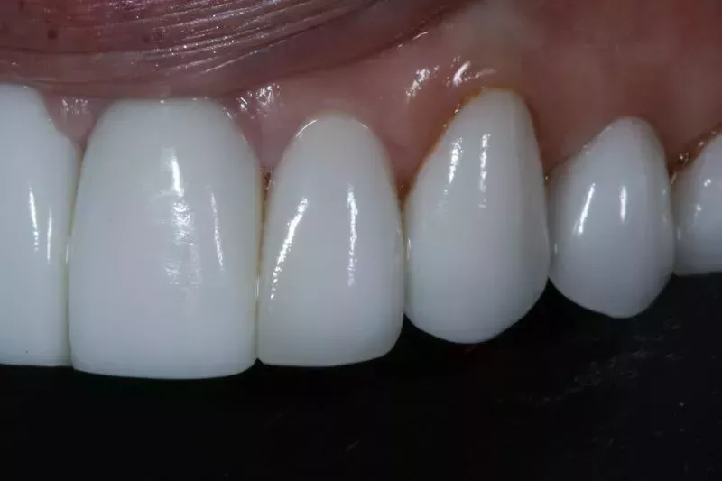 Before Porcelain veneers the difference