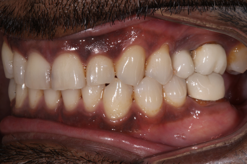 Before veneers and implants