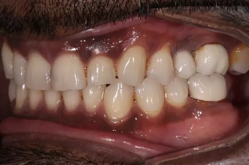 Before veneers and implants