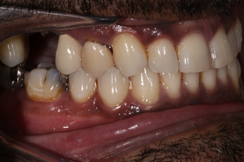 Before veneers and implants