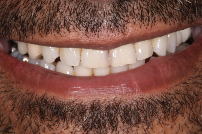 Before Veneers The Knightsbridge Clinic