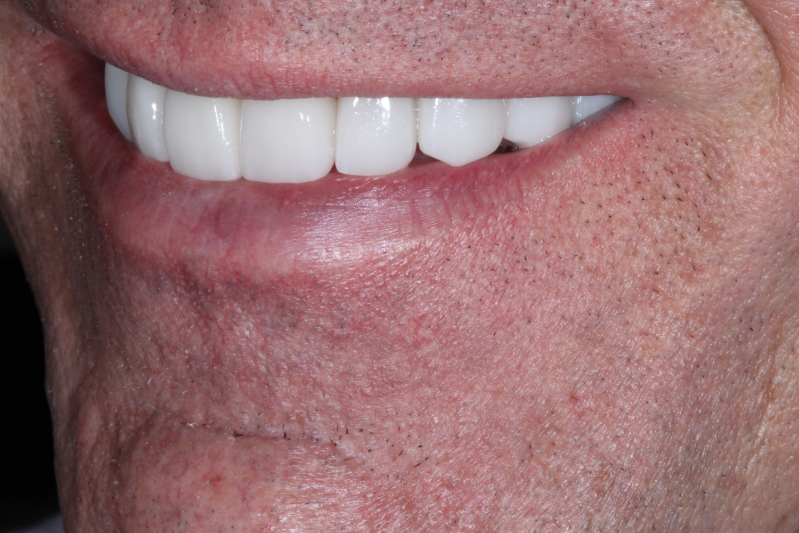 Before Porcelain veneers the difference