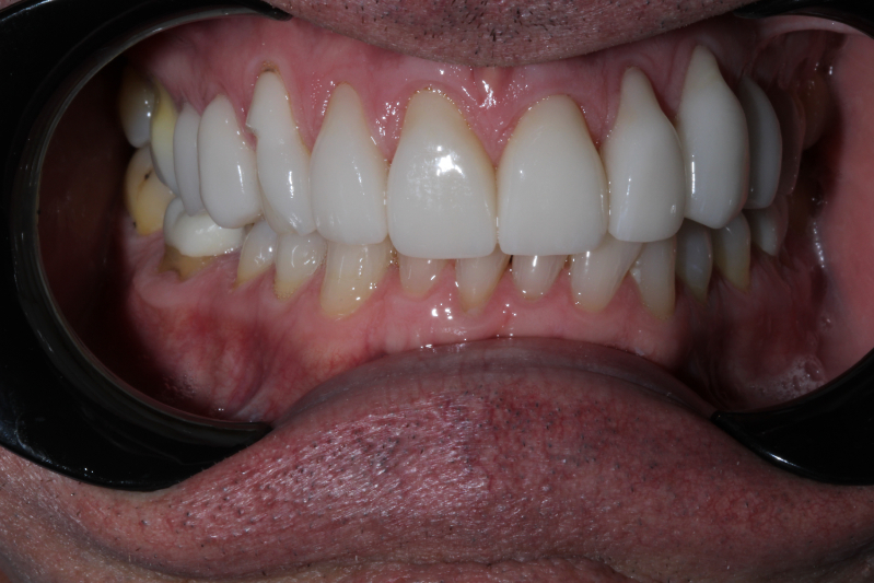 Before Porcelain veneers the difference