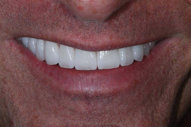 After Porcelain veneers the difference